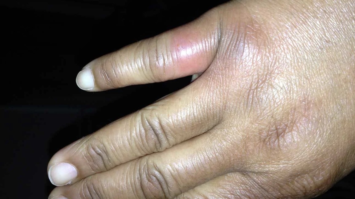 brown recluse spider bite on hand