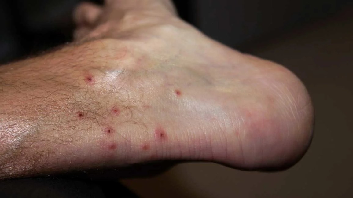 chigger bites