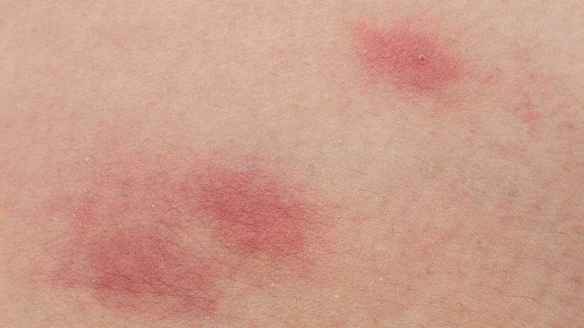 Flea bites are itchy, red bumps