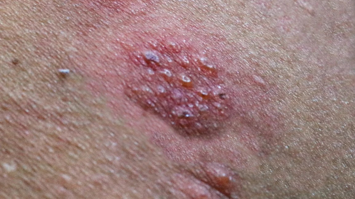 Close-up image of shingles blisters