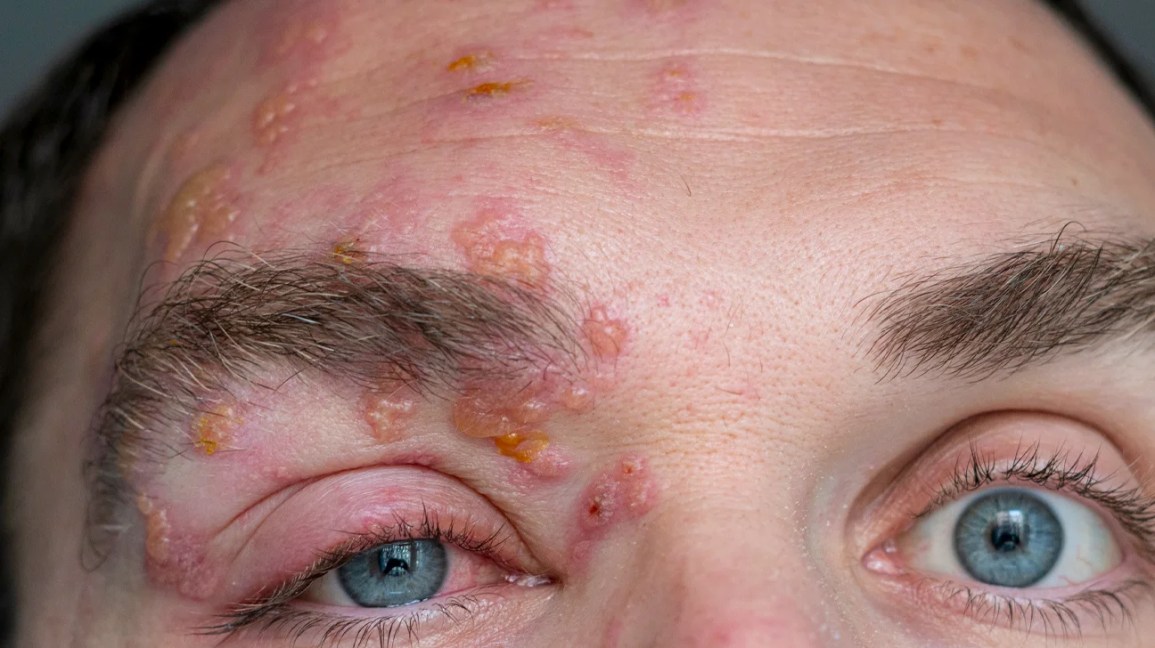 Picture of shingles rash on the face