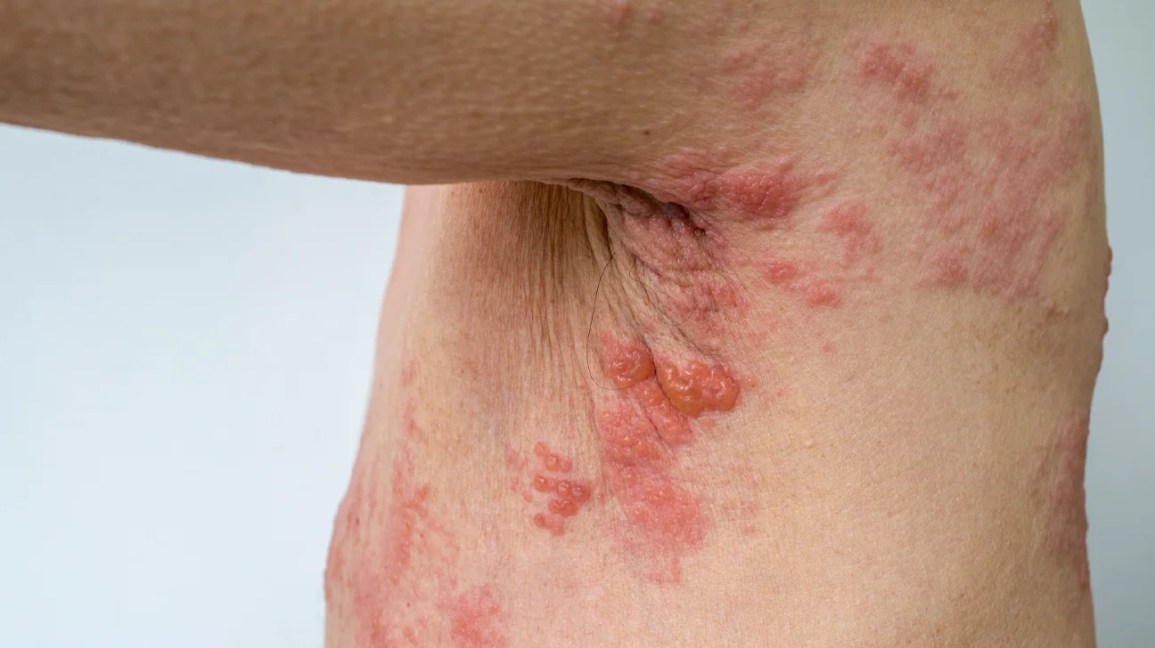 Picture of shingles rash under the arms