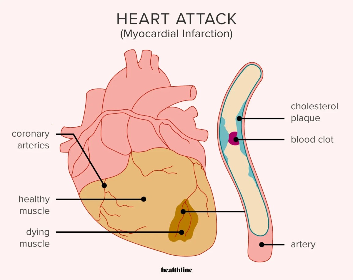 Diagram showing how a blood clot and plaque ruptures can cause a heart attack