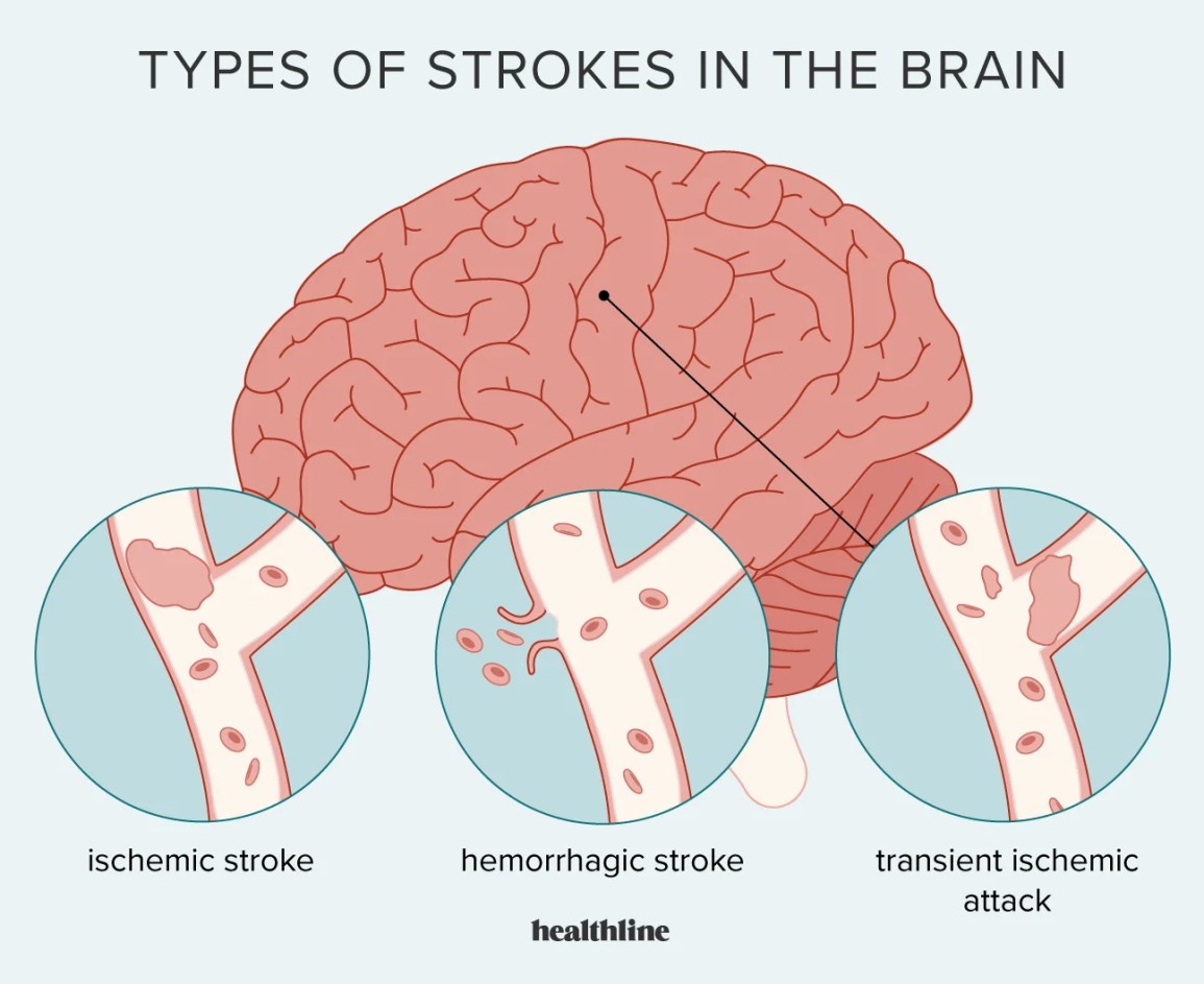 primary types of strokes: ischemic, hemorrhagic, and transient ischemic attack