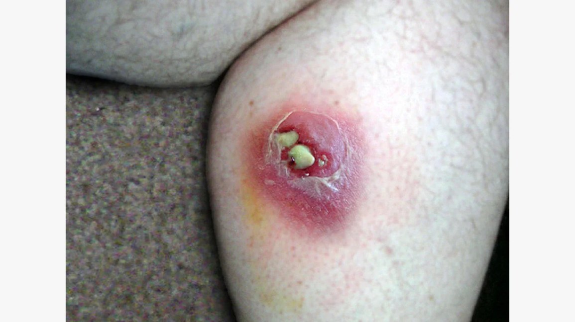 wolf spider bite