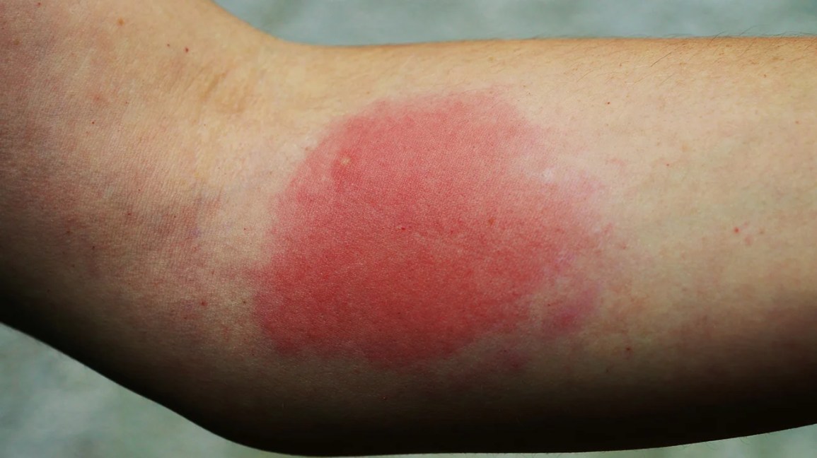 wasp sting